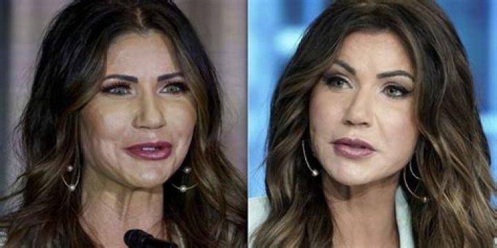 Kristy Noem's Plastic Surgery Journey Explored